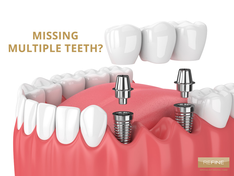 MISSING MULTIPLE TEETH?